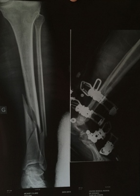 Bionic woman